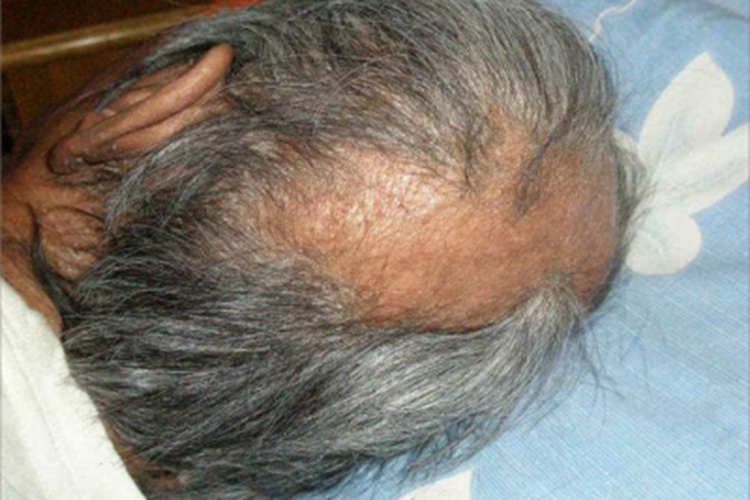 结核样型麻风头发脱落图