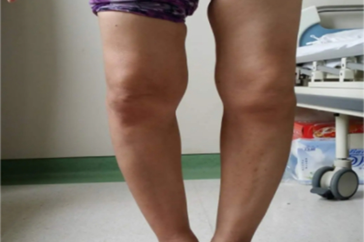 氟骨症腿畸形伸不直图