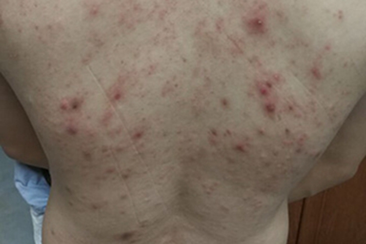 淋巴瘤样丘疹病背部小红疙瘩图 淋巴瘤样丘疹病背部小红疙瘩图