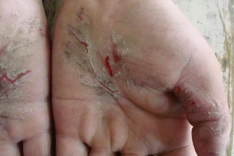 手足皲裂手掌裂纹图