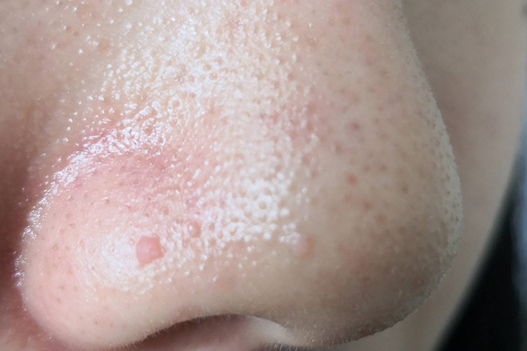 颜面部初期扁平疣图