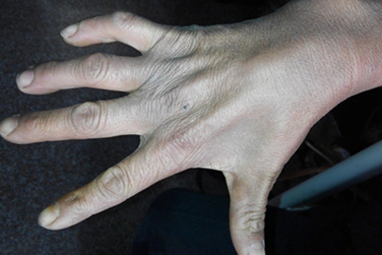 右手虎口肌肉萎缩图 右手虎口肌肉萎缩图