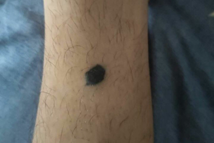 复合痣小腿黑痣图 复合痣小腿黑痣图