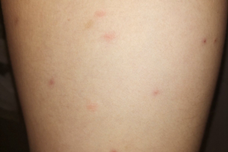 蚊性皮炎大腿红斑图