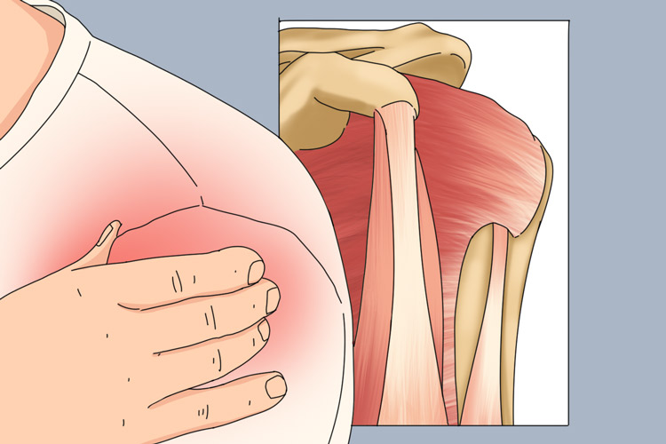 肩周炎图