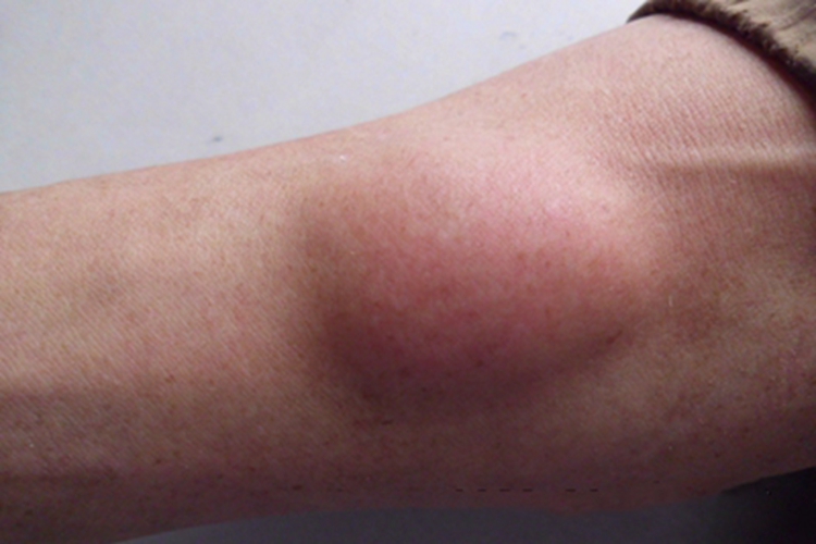 Ⅱ型痛性肥胖病大包图 Ⅱ型痛性肥胖病大包图