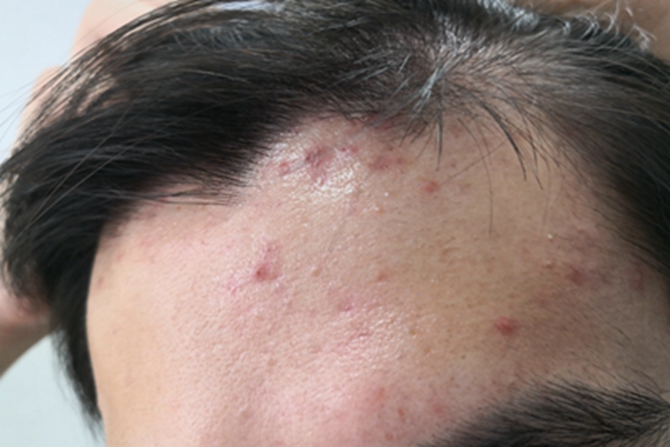 马拉色菌毛囊炎前额症状图