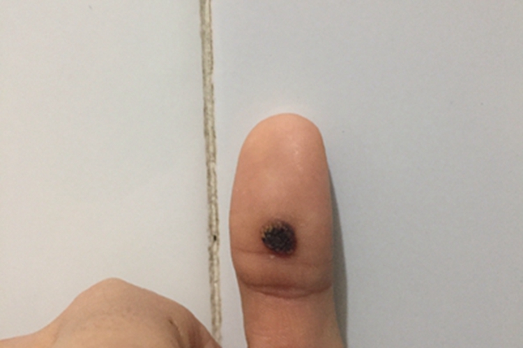 化脓性肉芽肿手指结痂图