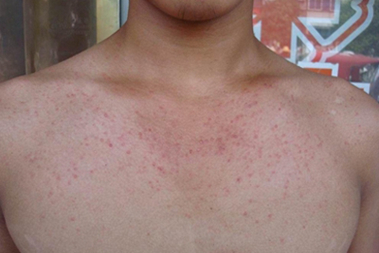 艾滋病胸部症状图