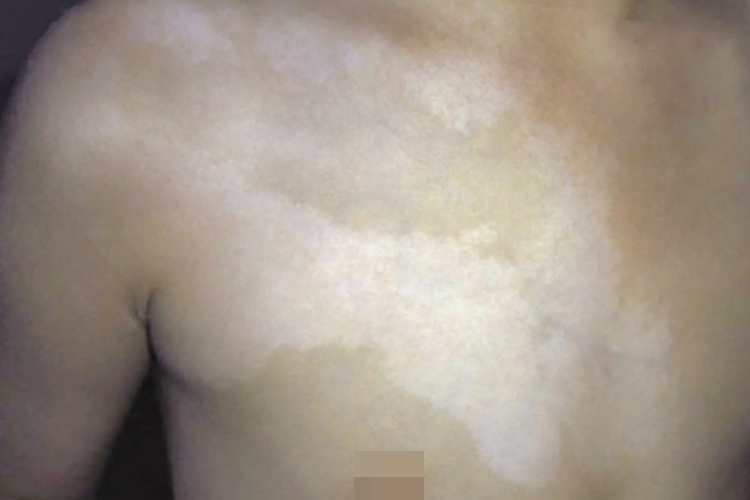 脱色素性痣胸部症状图(需打码) 脱色素性痣胸部症状图(需打码)