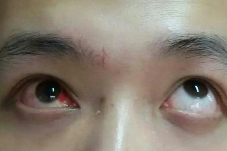 眼眶非爆裂性骨折图 眼眶非爆裂性骨折图