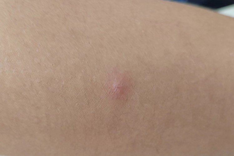 水痘胳膊丘疹图