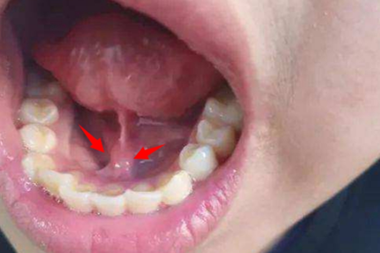 颌下腺导管口图