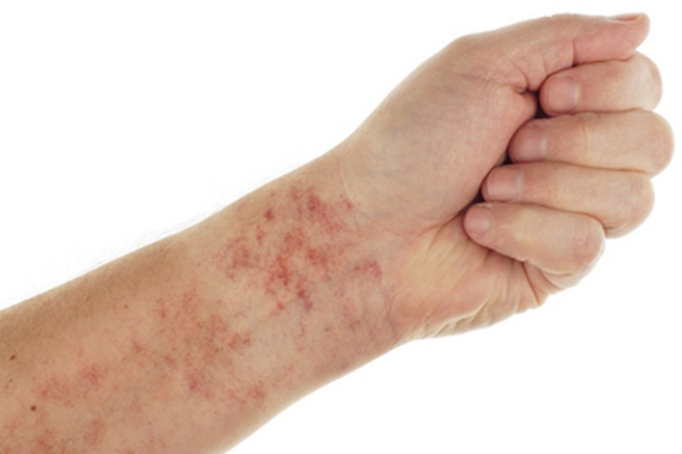 红皮病慢性期胳膊皮肤颜色加深图