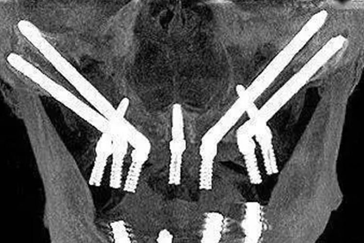 穿颧骨种植牙示意图