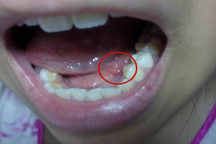 舌癌舌系带旁有白色溃疡图 舌癌舌系带旁有白色溃疡图