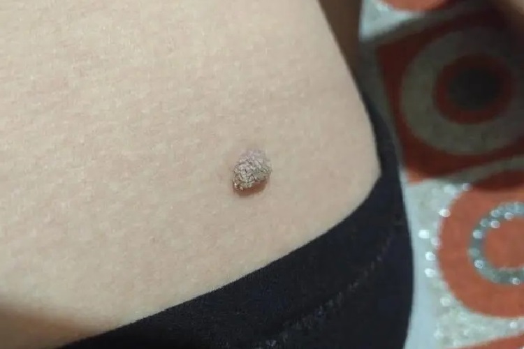 角化棘皮瘤裂纹图