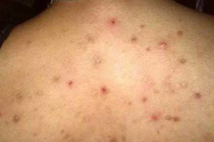 热带痤疮背部结痂图