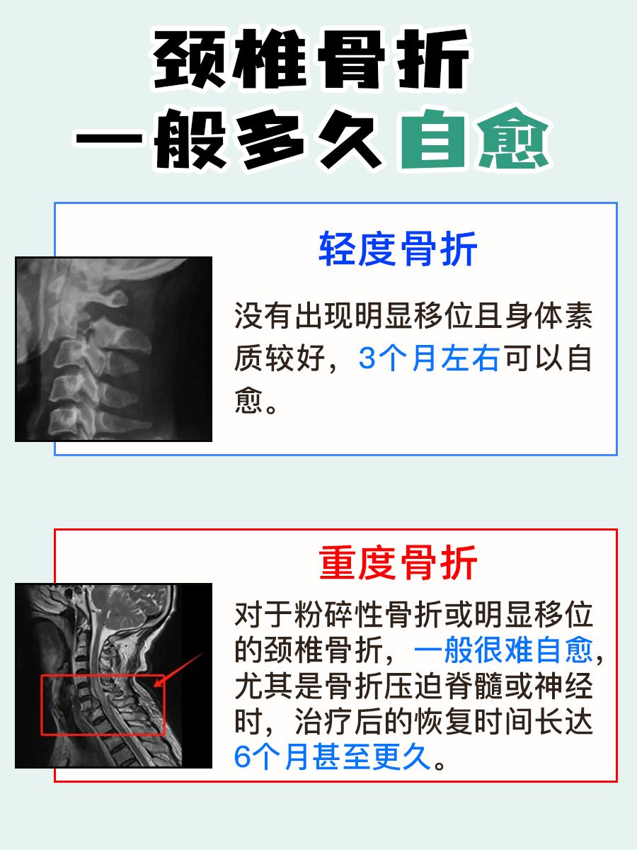 别再瞎猜了!颈椎骨折自愈时间一次说清楚