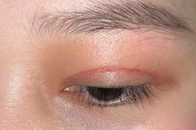 割双眼皮术后第7天图