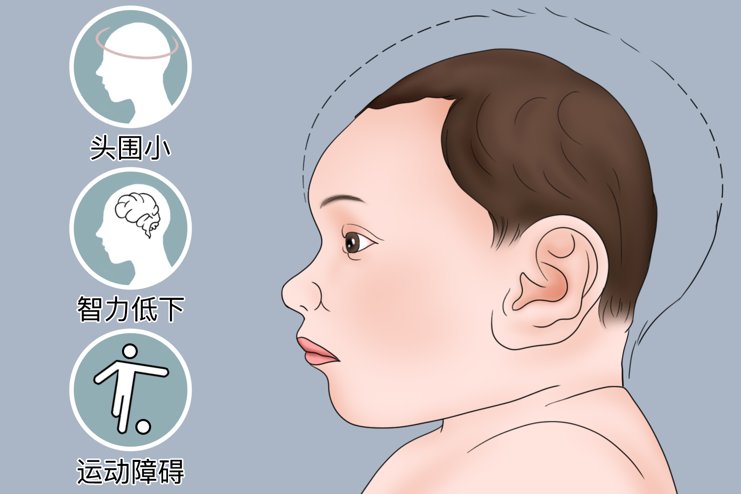13-三体综合征小颅图