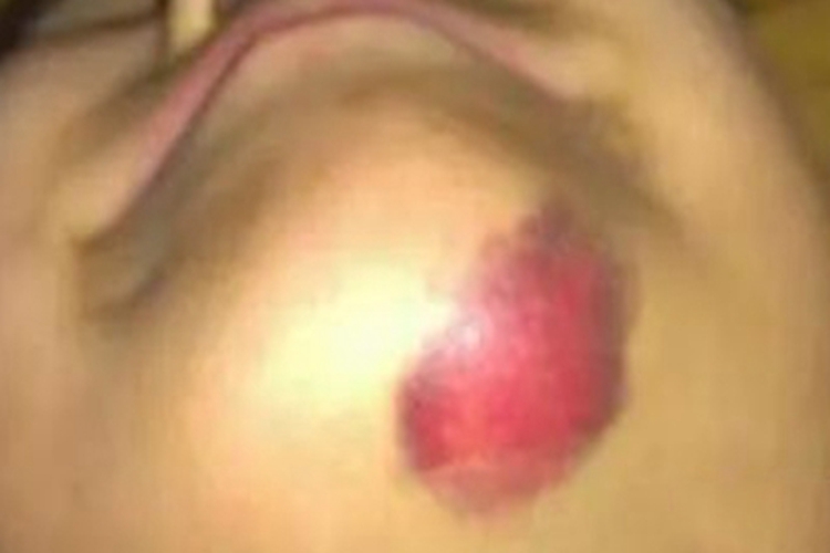 血友病A下巴紫斑图