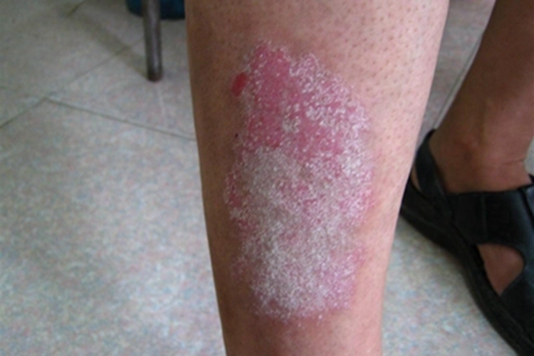 苔藓样型副银屑病脱屑图