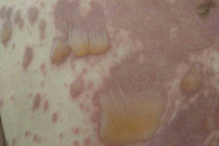 多形红斑型药疹背部大水疱图 多形红斑型药疹背部大水疱图