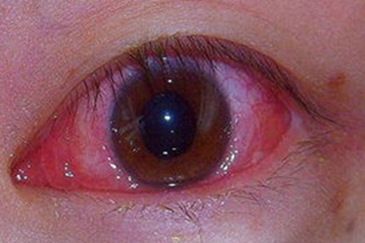 急性或亚急性细菌性结膜炎充血图