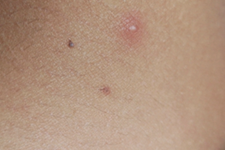 毛囊炎颈部长了个脓包图 毛囊炎颈部长了个脓包图