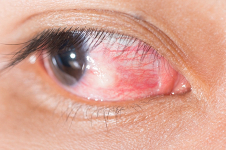 结节性前巩膜炎血丝图 结节性前巩膜炎血丝图