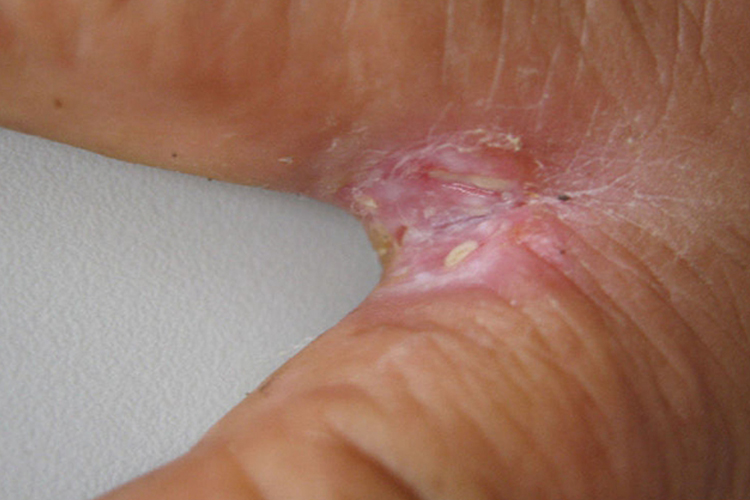 浸渍糜烂型手癣图
