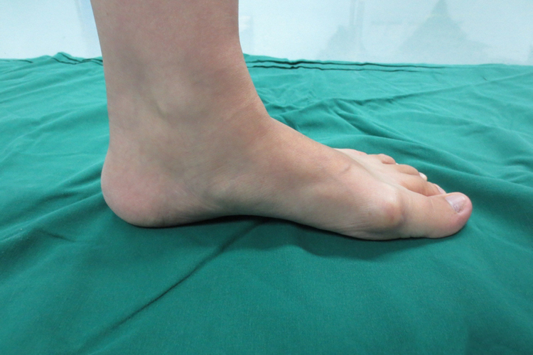 柔韧性扁平足图