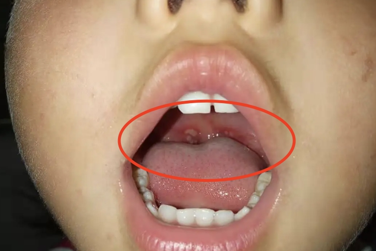 溃疡性口炎上颚红点像出血图