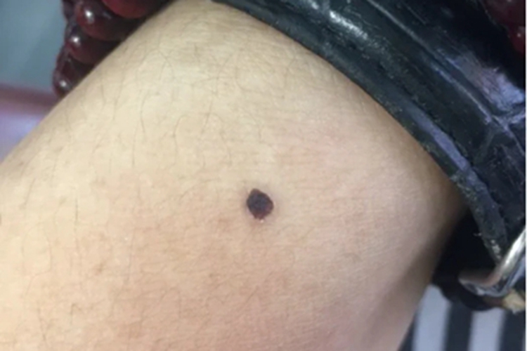 交界痣胳膊上黑了一块图