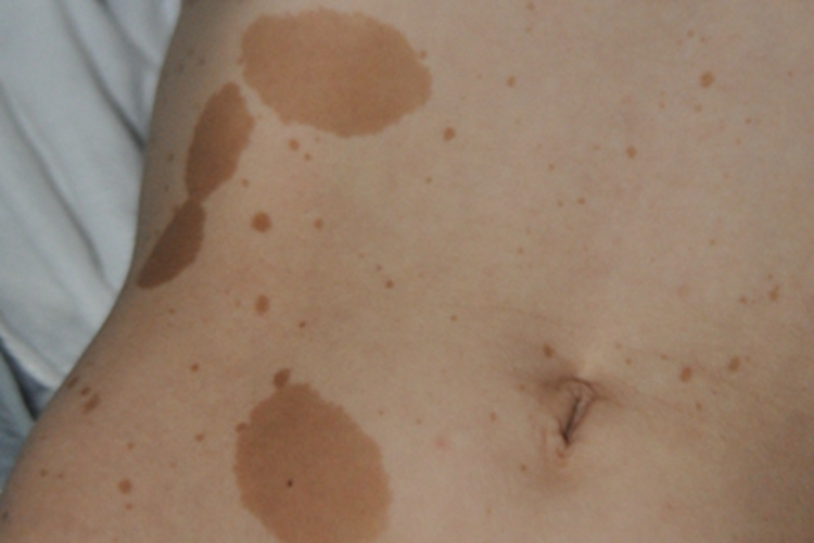 共济失调毛细血管扩张症腹部斑图