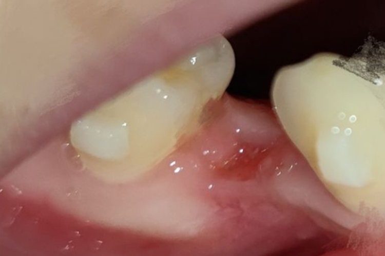 牙槽窝纤维组织形成图