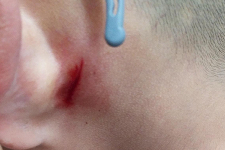 撞伤耳后裂口图 撞伤耳后裂口图