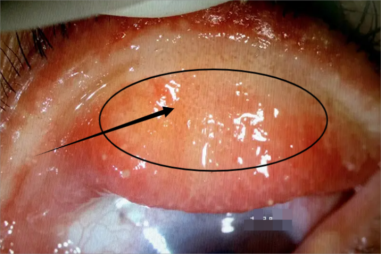 眼睑皮脂腺癌斑图