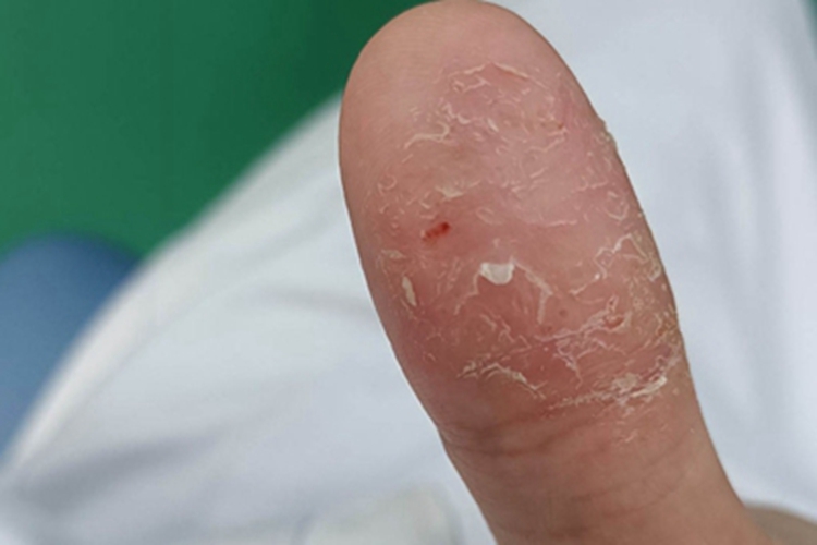 慢性湿疹手指干燥脱皮图