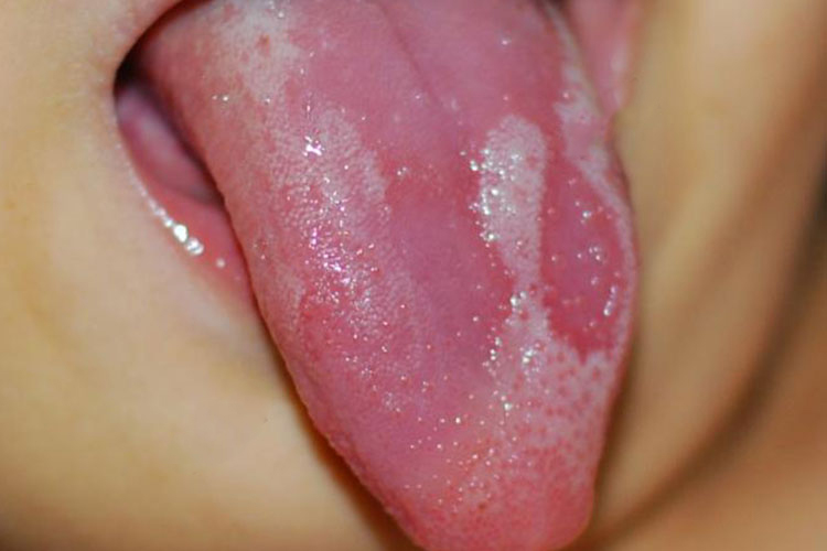 地图舌图<br />
地图舌图<br />