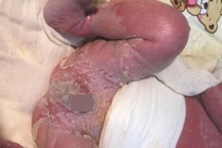 胶样婴儿腿症状图