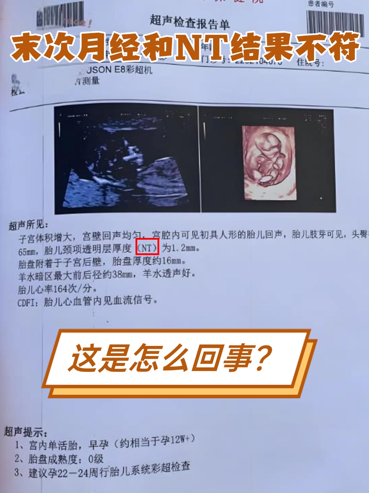 末次月经和NT结果不符，这是怎么回事？