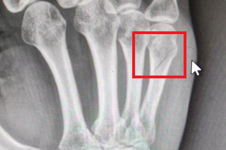 骨折手掌骨头有裂口图 骨折手掌骨头有裂口图