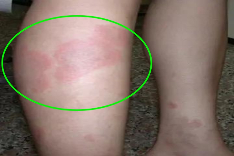 蛋白胨性荨麻疹小腿红斑图 蛋白胨性荨麻疹小腿红斑图