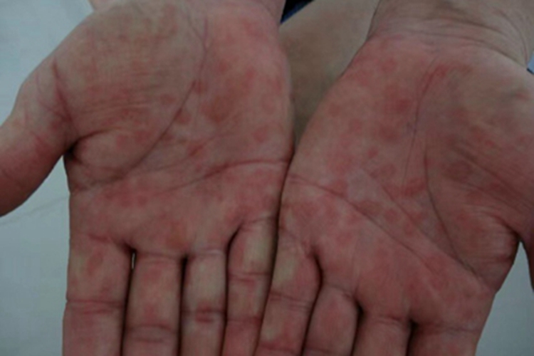 二期梅毒手掌上好多红斑图