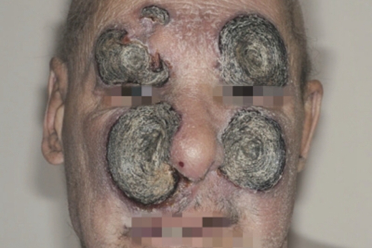 蕈样肉芽肿肿瘤期图 蕈样肉芽肿肿瘤期图