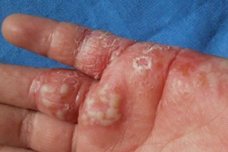 单纯疱疹化脓图 单纯疱疹化脓图