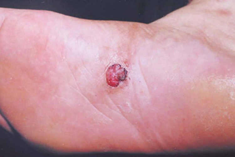 海鱼分枝杆菌感染脚底大红疙瘩图