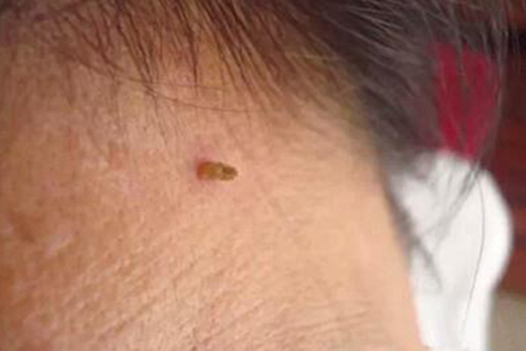丝状疣后脖子上长个小肉揪图